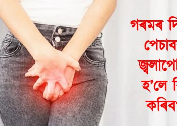 গৰমৰ দিনত পেচাবৱ জ্বলাপোৰা হ’লে কি কৰিব?