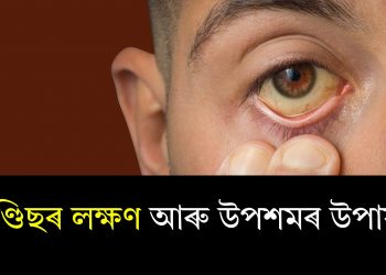 জণ্ডিছৰ লক্ষণ আৰু উপশমৰ উপায়…