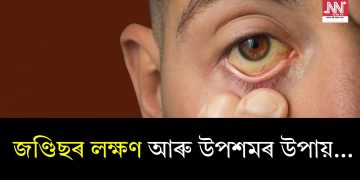 জণ্ডিছৰ লক্ষণ আৰু উপশমৰ উপায়…