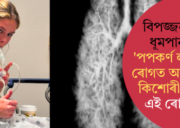 বিপজ্জনক ধূমপান! ‘পপকৰ্ণ লাংছ’ ৰোগত আক্ৰান্ত কিশোৰী, কি এই ৰোগ?