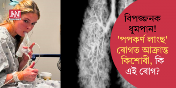 বিপজ্জনক ধূমপান! ‘পপকৰ্ণ লাংছ’ ৰোগত আক্ৰান্ত কিশোৰী, কি এই ৰোগ?