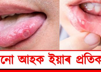 মুখৰ ভিতৰত ঘাঁ কিয় হয়? জানো আহক প্ৰতিকাৰ