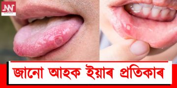 মুখৰ ভিতৰত ঘাঁ কিয় হয়? জানো আহক প্ৰতিকাৰ
