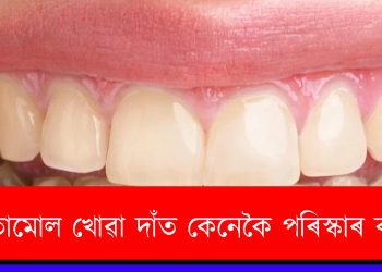 পাণ-তামোল খোৱা দাঁত কেনেকৈ পৰিস্কাৰ কৰিব?