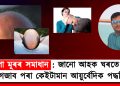 তপা মূৰৰ সমাধান : জানো আহক ঘৰতে চুলি গজাব পৰা কেইটামান আয়ুৰ্বেদিক পদ্ধতি