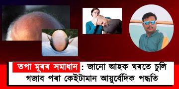 তপা মূৰৰ সমাধান : জানো আহক ঘৰতে চুলি গজাব পৰা কেইটামান আয়ুৰ্বেদিক পদ্ধতি