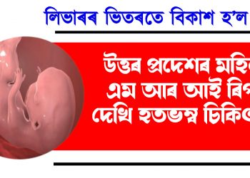 লিভাৰৰ ভিতৰতে বিকাশ হ’ল ভ্ৰুণ! উত্তৰ প্ৰদেশৰ মহিলাৰ এম আৰ আই ৰিপৰ্ট দেখি হতভম্ব চিকিৎসক