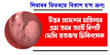 লিভাৰৰ ভিতৰতে বিকাশ হ’ল ভ্ৰুণ! উত্তৰ প্ৰদেশৰ মহিলাৰ এম আৰ আই ৰিপৰ্ট দেখি হতভম্ব চিকিৎসক