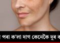 ছালৰ পৰা ক’লা দাগ কিদৰে দূৰ কৰিব? জানো আহক