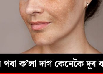 ছালৰ পৰা ক’লা দাগ কিদৰে দূৰ কৰিব? জানো আহক