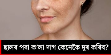 ছালৰ পৰা ক’লা দাগ কিদৰে দূৰ কৰিব? জানো আহক