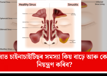 বাৰিষাত চাইনাচাইটিছৰ সমস্যা কিয় বাঢ়ে আৰু কেনেকৈ নিয়ন্ত্ৰণ কৰিব?