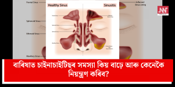 বাৰিষাত চাইনাচাইটিছৰ সমস্যা কিয় বাঢ়ে আৰু কেনেকৈ নিয়ন্ত্ৰণ কৰিব?