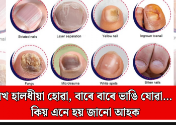 নখ হালধীয়া হোৱা, বাৰে বাৰে ভাঙি যোৱা… কিয় এনে হয় জানো আহক