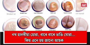 নখ হালধীয়া হোৱা, বাৰে বাৰে ভাঙি যোৱা… কিয় এনে হয় জানো আহক