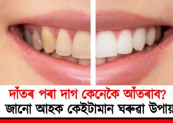 দাঁতৰ পৰা দাগ কেনেকৈ আঁতৰাব? জানো আহক কেইটামান ঘৰুৱা উপায়