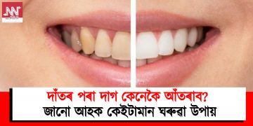 দাঁতৰ পৰা দাগ কেনেকৈ আঁতৰাব? জানো আহক কেইটামান ঘৰুৱা উপায়
