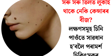 সৰু সৰু তিলত লুকাই থাকে নেকি কেন্সাৰৰ বীজ? লক্ষণসমূহ চিনি পাওঁতে সাৱধান হ’বলৈ পৰামৰ্শ চিকিৎসকৰ