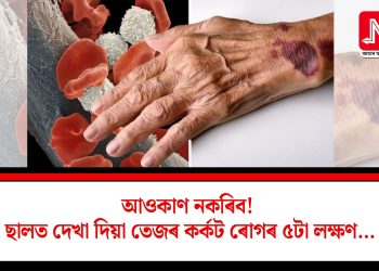আওকাণ নকৰিব! ছালত দেখা দিয়া তেজৰ কৰ্কট ৰোগৰ ৫টা লক্ষণ…