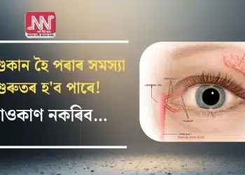 চকু শুকান হৈ পৰাৰ সমস্যা গুৰুতৰ হ’ব পাৰে! আওকাণ নকৰিব…