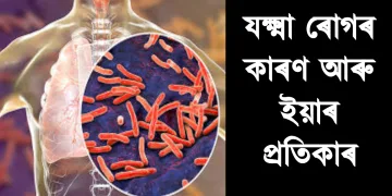 যক্ষ্মা ৰোগৰ কাৰণ আৰু ইয়াৰ প্ৰতিকাৰ