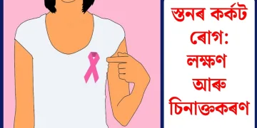 স্তনৰ কৰ্কট ৰোগ: লক্ষণ আৰু চিনাক্তকৰণ