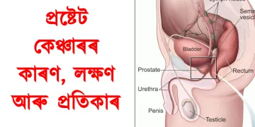 প্ৰষ্টেট কেঞ্চাৰৰ কাৰণ, লক্ষণ আৰু প্ৰতিকাৰ
