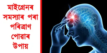 মাইগ্ৰেনৰ সমস্যাৰ পৰা পৰিত্ৰাণ পোৱাৰ উপায়