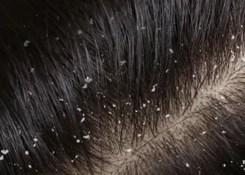 শীতকালত কিদৰে পৰিত্ৰাণ পাব উফিৰ সমস্যাৰ পৰা?