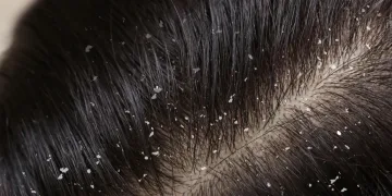 শীতকালত কিদৰে পৰিত্ৰাণ পাব উফিৰ সমস্যাৰ পৰা?