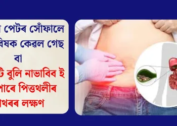 সাৱধান পেটৰ সোঁফালে হোৱা বিষক কেৱল গেছ বা এচিডিটি বুলি নাভাবিব ই হ’ব পাৰে পিত্তথলীৰ পাথৰৰ লক্ষণ