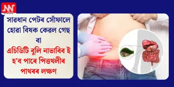 সাৱধান পেটৰ সোঁফালে হোৱা বিষক কেৱল গেছ বা এচিডিটি বুলি নাভাবিব ই হ’ব পাৰে পিত্তথলীৰ পাথৰৰ লক্ষণ