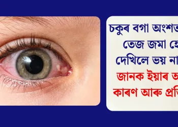 চকুৰ বগা অংশত হঠাৎ তেজ জমা হোৱা দেখিলে ভয় নাখাব, জানক ইয়াৰ আচল কাৰণ আৰু প্ৰতিকাৰ