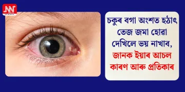 চকুৰ বগা অংশত হঠাৎ তেজ জমা হোৱা দেখিলে ভয় নাখাব, জানক ইয়াৰ আচল কাৰণ আৰু প্ৰতিকাৰ