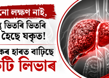 কোনো লক্ষণ নাই, কিন্তু ভিতৰি ভিতৰি নষ্ট হৈছে যকৃত! ভয়ংকৰ হাৰত বাঢ়িছে ফেটি লিভাৰ