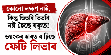 কোনো লক্ষণ নাই, কিন্তু ভিতৰি ভিতৰি নষ্ট হৈছে যকৃত! ভয়ংকৰ হাৰত বাঢ়িছে ফেটি লিভাৰ